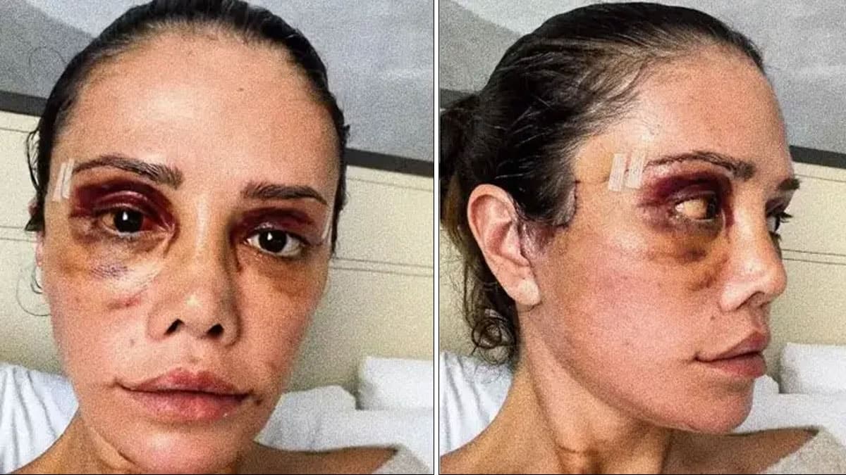 İkinci yüz nakli sonrası felç geçiren Didem Ceran'dan yeni hamle